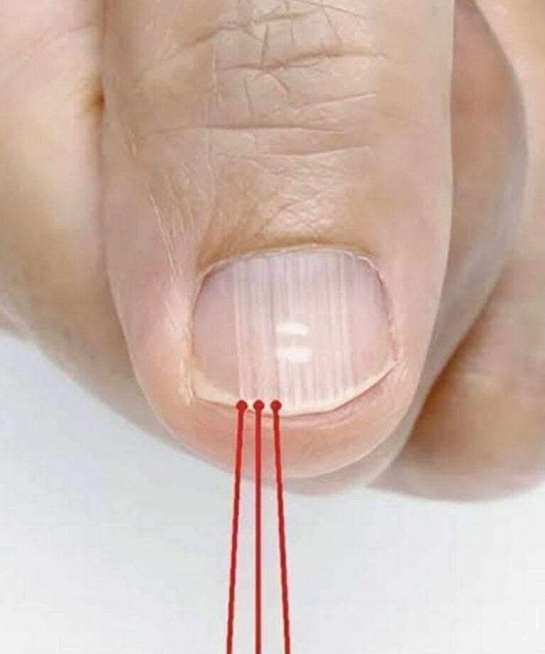 What Vertical Ridges on Your Nails Mean After 40